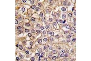 IHC analysis of FFPE human prostate carcinoma tissue stained with IL1R1 antibody (IL1R1 antibody  (AA 474-503))