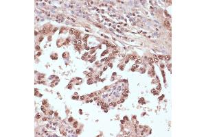 Immunohistochemistry of paraffin-embedded human lung cancer using Rad50 antibody (ABIN3017329, ABIN3017330, ABIN3017331 and ABIN6220043) at dilution of 1:100 (40x lens). (RAD50 antibody  (AA 1-100))