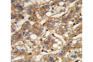IHC analysis of FFPE human hepatocarcinoma with IFNB1 antibody (IFNB1 antibody  (AA 39-66))