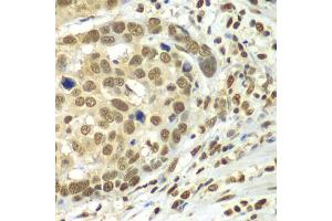 Immunohistochemistry of paraffin-embedded human esophageal cancer using HDAC2 antibody (ABIN1872954) at dilution of 1:100 (40x lens). (HDAC2 antibody)