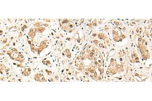 Immunohistochemistry of paraffin-embedded Human prost ate cancer tissue using GPR139 Polyclonal Antibody at dilution of 1:50(x200) (GPR139 antibody)