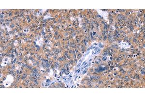 Immunohistochemistry of paraffin-embedded Human ovarian cancer tissue using ZNF395 Polyclonal Antibody at dilution 1:40 (ZNF395 antibody)