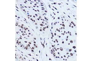 Immunohistochemistry of paraffin-embedded human esophageal cancer using SSB Rabbit pAb (ABIN3015264, ABIN3015265, ABIN3015266 and ABIN6213909) at dilution of 1:300 (40x lens). (SSB antibody  (AA 166-408))