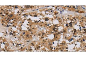 Immunohistochemistry of paraffin-embedded Human thyroid cancer tissue using E2F4 Polyclonal Antibody at dilution 1:40 (E2F4 antibody)