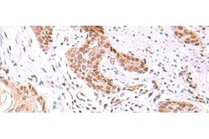 Immunohistochemistry of paraffin-embedded Human esophagus cancer tissue using TRMT12 Polyclonal Antibody at dilution of 1:80(x200) (TRMT12 antibody)