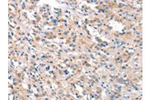 The image on the left is immunohistochemistry of paraffin-embedded Human thyroid cancer tissue using ABIN7191162(KCNB1 Antibody) at dilution 1/40, on the right is treated with synthetic peptide. (Kv2.1/KCNB1 antibody)