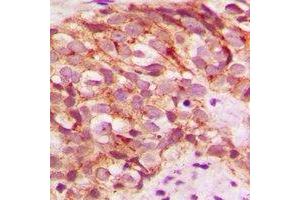 Immunohistochemical analysis of Glycerate Kinase staining in human breast cancer formalin fixed paraffin embedded tissue section. (GLYCTK antibody)