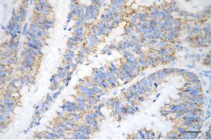 Immunohistochemistry was performed on paraffin-embedded human sigmoid colon carcinoma using COXIV antibody (ABIN7798246), 1:200).