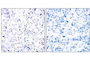 Immunohistochemical analysis of paraffin-embedded human breast carcinoma tissue using Rb (Ab-807) antibody (E021109). (Retinoblastoma 1 antibody)