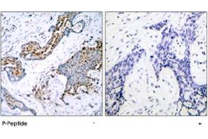 Immunohistochemical analysis of paraffin-embedded human breast carcinoma tissue using ESR1 (phospho S118) polyclonal antibody . (Estrogen Receptor alpha antibody  (pSer118))
