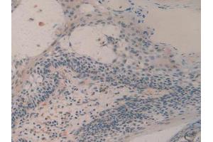 IHC-P analysis of Human Skin Cancer Tissue, with DAB staining. (H2AFY antibody  (AA 109-369))
