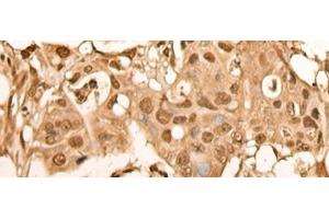Immunohistochemistry of paraffin-embedded Human colorectal cancer tissue using BRF2 Polyclonal Antibody at dilution of 1:40(x200)