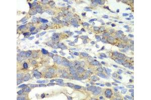 Immunohistochemistry of paraffin-embedded Human gastric cancer using CHMP2B Polyclonal Antibody at dilution of 1:100 (40x lens). (CHMP2B antibody)