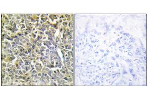 Immunohistochemistry analysis of paraffin-embedded human lung carcinoma tissue using COL6A2 antibody. (COL6A2 antibody  (Internal Region))