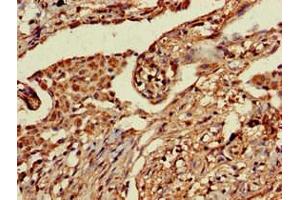 Immunohistochemistry of paraffin-embedded human lung cancer using ABIN7164763 at dilution of 1:100 (PRR11 antibody  (AA 1-360))