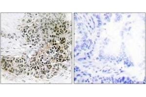 Immunohistochemistry analysis of paraffin-embedded human lung carcinoma tissue, using TRPS1 Antibody. (TRPS1 antibody  (AA 121-170))