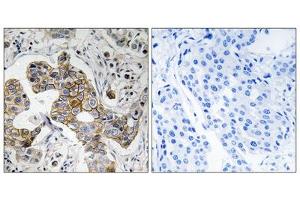 Immunohistochemistry analysis of paraffin-embedded human breast carcinoma tissue using KCNK15 antibody.