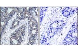 Immunohistochemistry analysis of paraffin-embedded human breast carcinoma, using IRS-1 (Phospho-Ser636) Antibody. (IRS1 antibody  (pSer636))
