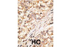 Formalin-fixed and paraffin-embedded human hepatocellular carcinoma tissue reacted with GJD2 polyclonal antibody  , which was peroxidase-conjugated to the secondary antibody, followed by DAB staining. (GJD2 antibody  (C-Term))