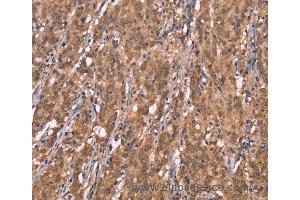 Immunohistochemistry of Human colon cancer using FBXO31 Polyclonal Antibody at dilution of 1:40