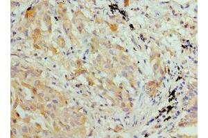 Immunohistochemistry of paraffin-embedded human lung cancer using ABIN7155429 at dilution of 1: 100 (HIST2H3A antibody  (AA 108-136))