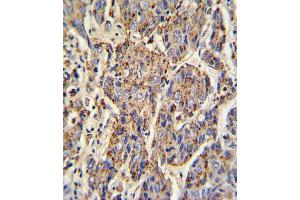 Formalin-fixed and paraffin-embedded human hepatocarcinoma with CATB Antibody , which was peroxidase-conjugated to the secondary antibody, followed by DAB staining. (Tyrosinase-Related Protein 1 antibody  (AA 198-227))