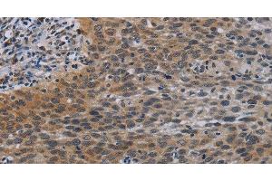 Immunohistochemistry of paraffin-embedded Human cervical cancer tissue using CCL1 Polyclonal Antibody at dilution 1:50 (CCL1 antibody)