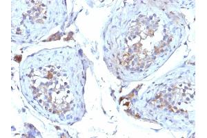 Formalin-fixed, paraffin-embedded human Testicular Carcinoma stained with SHBG Mouse Monoclonal Antibody (SHBG/245). (SHBG antibody)