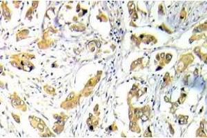 Immunohistochemistry (IHC) analyzes of p-FKHR/FOXO1A antibody in paraffin-embedded human breast carcinoma tissue.