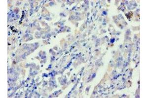Immunohistochemistry of paraffin-embedded human lung cancer using ABIN7144040 at dilution of 1:100 (FE65 antibody  (AA 361-710))
