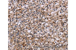 Immunohistochemistry of Human prostate cancer using NCSTN Polyclonal Antibody at dilution of 1:50