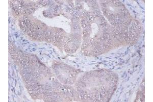 Immunohistochemistry of paraffin-embedded human colon cancer using ABIN7153940 at dilution of 1:100 (PRKCSH antibody  (AA 15-302))