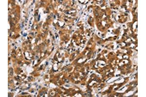 The image on the left is immunohistochemistry of paraffin-embedded Human esophagus cancer tissue using ABIN7192349(SH2B2 Antibody) at dilution 1/30, on the right is treated with synthetic peptide. (SH2B2 antibody)