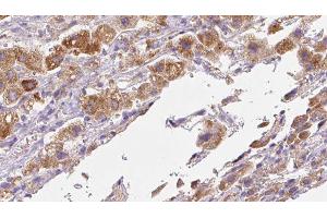 ABIN6279710 at 1/100 staining Human liver cancer tissue by IHC-P.