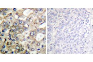 Peptide - +Immunohistochemical analysis of paraffin-embedded human breast carcinoma tissue using BTK (Ab-222) antibody (#B0054). (BTK antibody  (Tyr222))