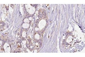 ABIN6267634 at 1/100 staining Human liver cancer tissue by IHC-P. (GRIN2B antibody  (pTyr1474))
