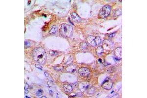 Immunohistochemical analysis of IRS1 (pS636) staining in human lung cancer formalin fixed paraffin embedded tissue section. (IRS1 antibody  (pSer636))