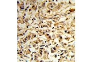 Formalin-fixed and paraffin-embedded human breast carcinoma reacted with MAT2B Antibody (N-term) followed which was peroxidase-conjugated to the secondary antibody, followed by DAB staining. (MAT2B antibody  (N-Term))