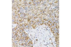 Immunohistochemistry of paraffin-embedded human lung cancer using PDYN antibody (ABIN2564462) at dilution of 1:100 (40x lens). (PDYN antibody)