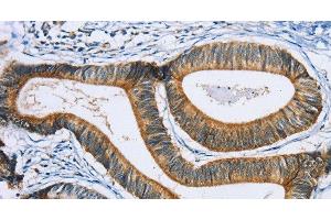 Immunohistochemistry of paraffin-embedded Human colon cancer using SULT1B1 Polyclonal Antibody at dilution of 1:30 (SULT1B1 antibody)