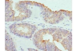 Immunohistochemistry of paraffin-embedded human endometrial cancer using ABIN7148039 at dilution of 1:100 (COCH antibody  (AA 20-260))