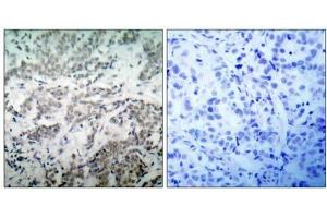 Immunohistochemical analysis of paraffin- embedded human breast carcinoma tissue using BCL-2(Ab-56) antibody (E021059). (Bcl-2 antibody)