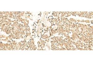 Immunohistochemistry of paraffin-embedded Human lung cancer tissue using TBPL1 Polyclonal Antibody at dilution of 1:50(x200)