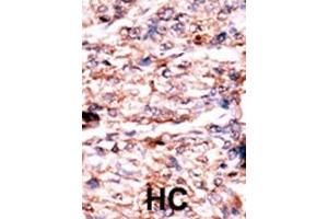 Formalin-fixed and paraffin-embedded human cancer tissue reacted with the primary antibody, which was peroxidase-conjugated to the secondary antibody, followed by AEC staining. (PSKH1 antibody  (N-Term))