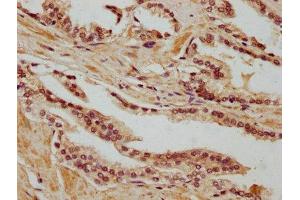 IHC image of ABIN7168592 diluted at 1:400 and staining in paraffin-embedded human prostate cancer performed on a Leica BondTM system. (SAGE1 antibody  (AA 3-133))