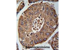 ACN9 Antibody (N-term) immunohistochemistry analysis in formalin fixed and paraffin embedded human hepatocarcinoma followed by peroxidase conjugation of the secondary antibody and DAB staining. (ACN9 antibody  (N-Term))