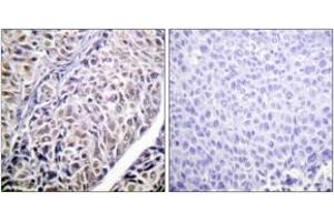 Immunohistochemistry analysis of paraffin-embedded human liver carcinoma tissue, using AurB (Ab-12) Antibody. (Aurora Kinase B antibody  (AA 1-50))