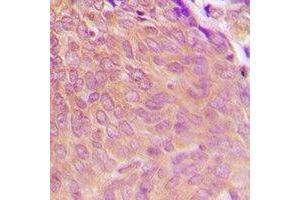 Immunohistochemical analysis of PPP2CA staining in human breast cancer formalin fixed paraffin embedded tissue section. (PPP2CA antibody  (C-Term))