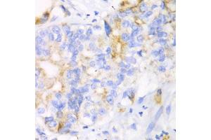 Immunohistochemistry of paraffin-embedded human liver cancer using CHIA antibody (ABIN5971776) at dilution of 1/100 (40x lens). (CHIA antibody)