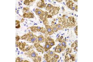 Immunohistochemistry of paraffin-embedded liver cancer using GATM antibody at dilution of 1:100 (x400 lens).